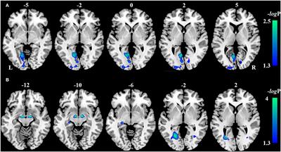 Brain Gray Matter Atrophy and Functional Connectivity Remodeling in Patients With Chronic LHON